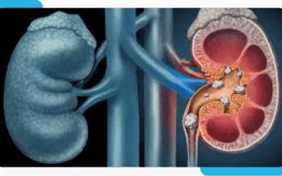 Kidney Stone Removal: Options and What to Expect