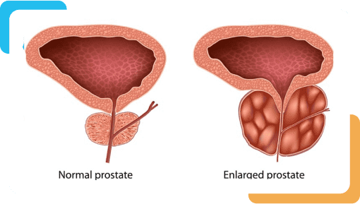 Prostate-Care-Urocentre-Services